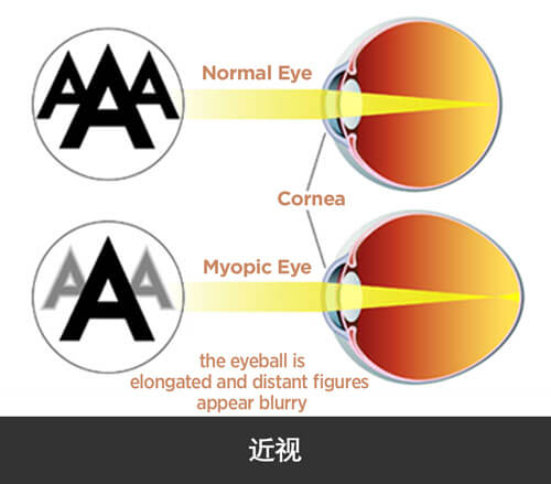 jl-eye-specialists-clinic-singapore-short-sightedness-myopia